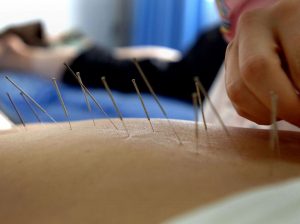 acupuncture