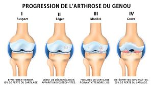 l’arthrose